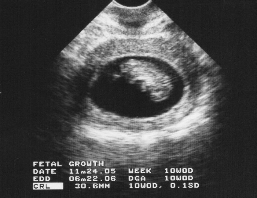 妊娠10週 つわりは落ち着く お腹の大きさやエコー写真は こそだてハック