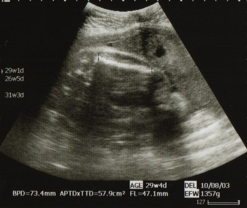 今日から妊娠29週 胎児の体重や大きさは 逆子対策は必要 こそだてハック