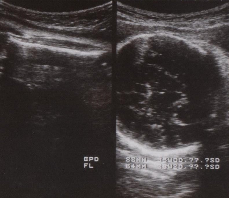 妊娠35週の胎児の体重や大きさは 早産で出産する影響は こそだてハック