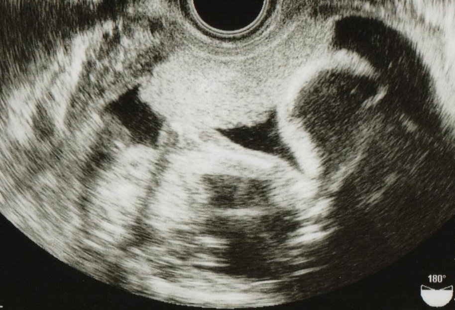 妊娠17週 胎児やお腹の大きさ 体重は こそだてハック