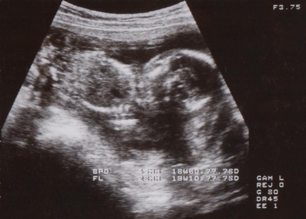 妊娠18週 胎児やお腹の大きさ 体重は こそだてハック