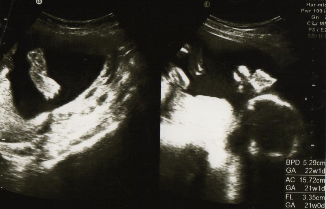 妊娠22週の壁 とは 流産 早産と関係があるの こそだてハック