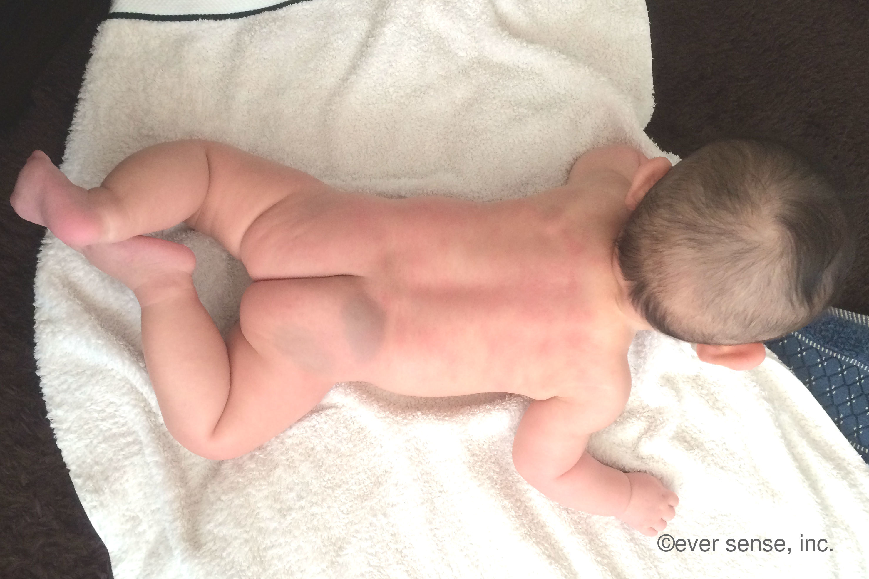 蒙古斑はいつ消える 背中や腕 足 お尻 顔にできたあざの判別法は こそだてハック