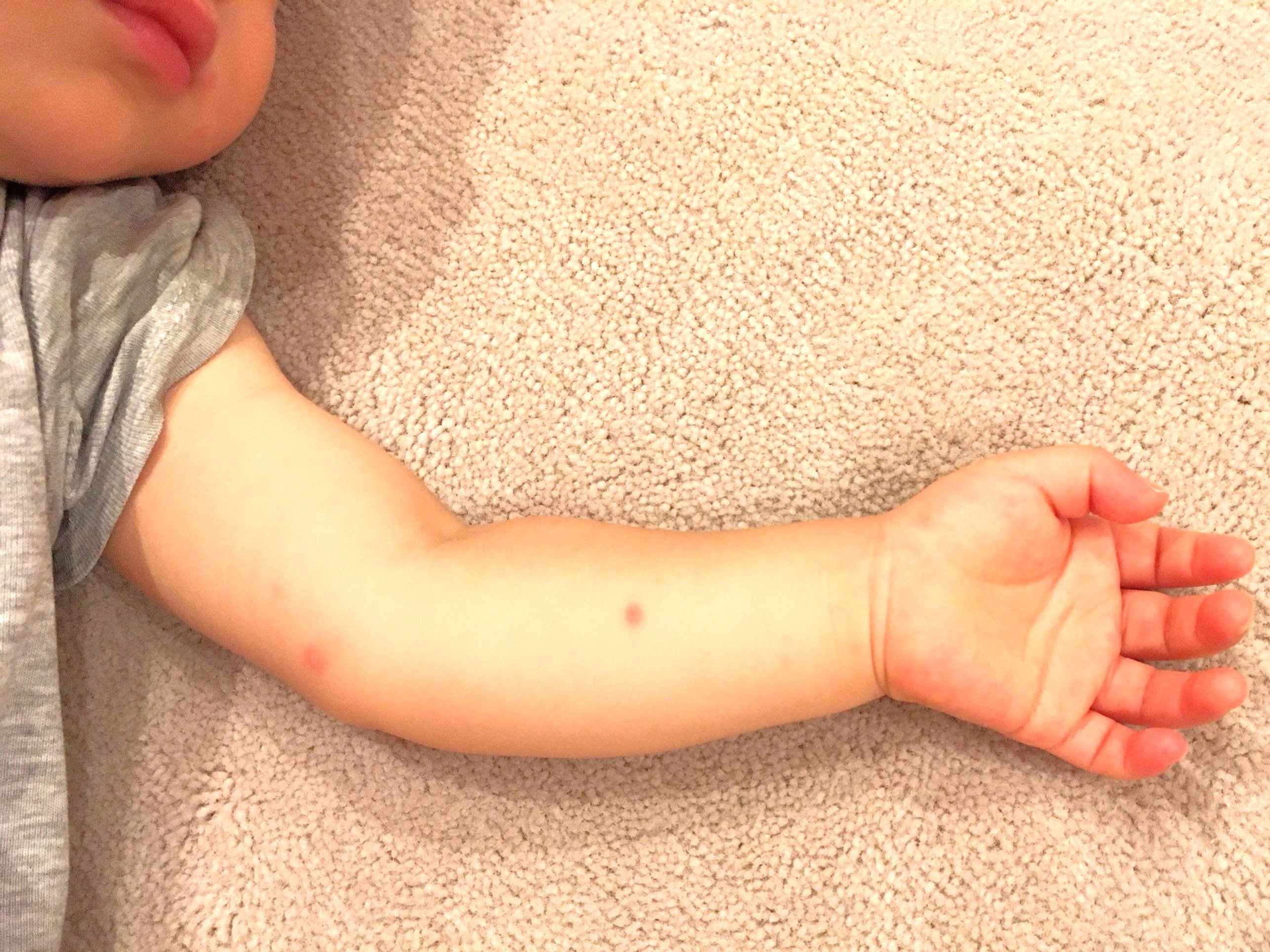 写真あり 手足口病の初期症状 これらが見られたら落ち着いて病院へ こそだてハック