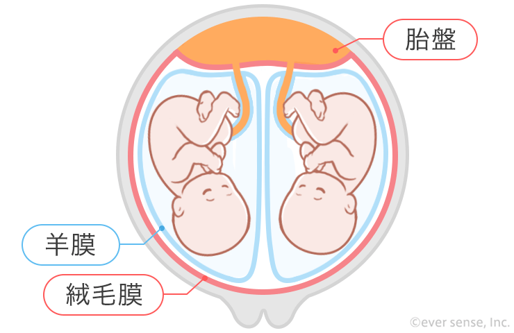 Ddツイン Mdツイン Mmツインとは リスクはあるの こそだてハック